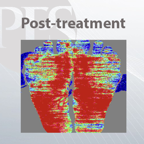 post-treatment anodyne